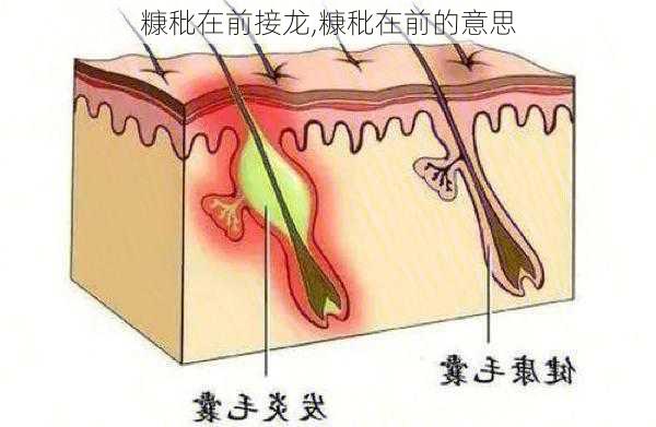 糠秕在前接龙,糠秕在前的意思